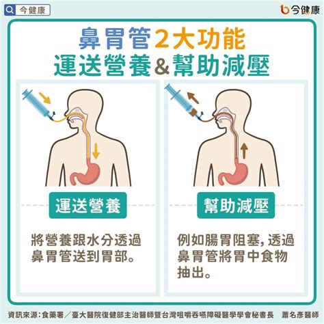 鼻胃管反抽顏色代表意義|鼻胃管的居家照顧